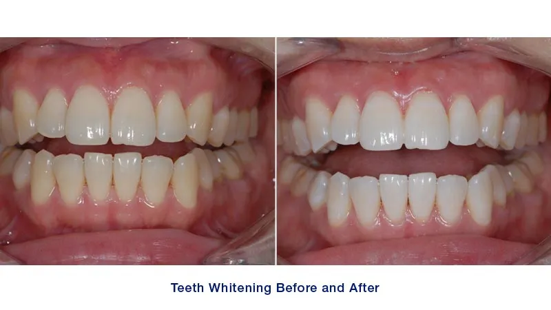 /img/25888-teeth-whitening-results.webp