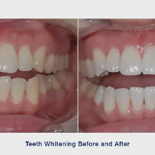 /img/25888-teeth-whitening-results.webp