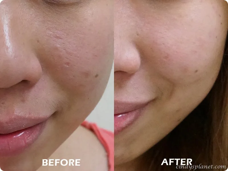 25891 applying cream