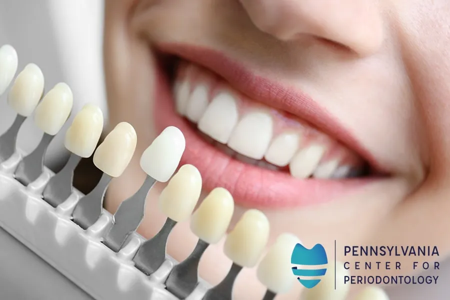 25894 professional teeth whitening 3