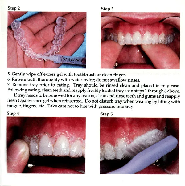 25897 consistent use teeth whitening