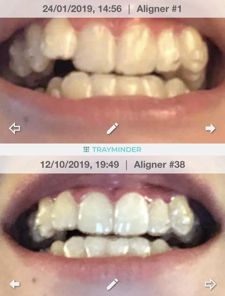 25897 teeth whitening tray types