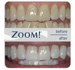 25899 at home whitening kits