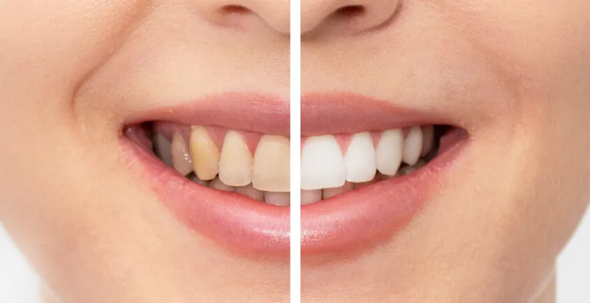 25899 professional teeth whitening