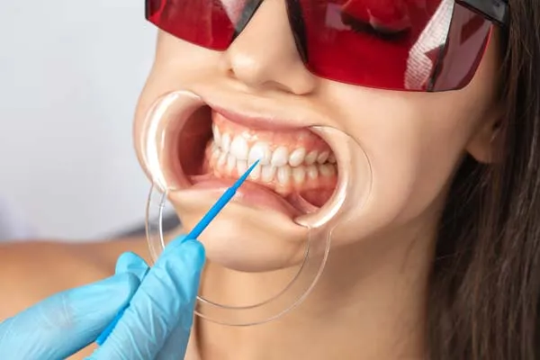 25899 teeth whitening aftercare