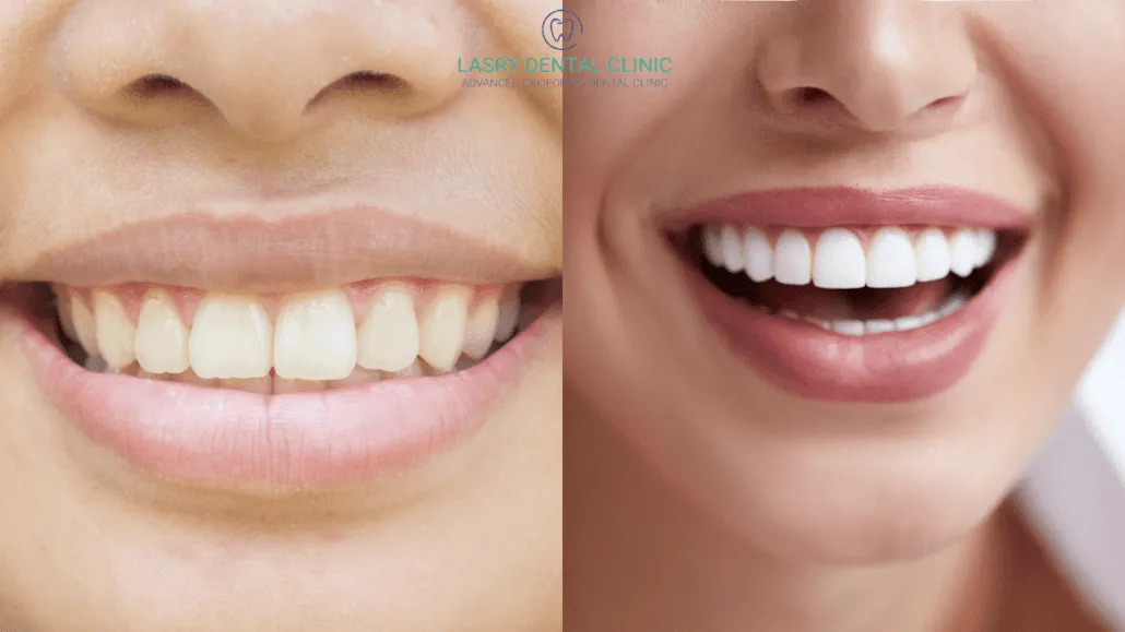 25900 affordable teeth whitening
