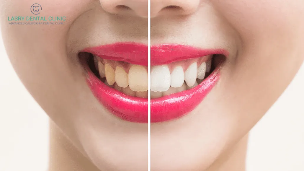 25900 at home teeth whitening