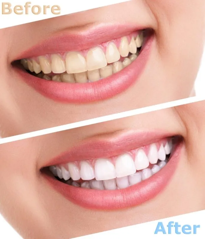 /img/25900-smile-makeover-los-angeles.webp