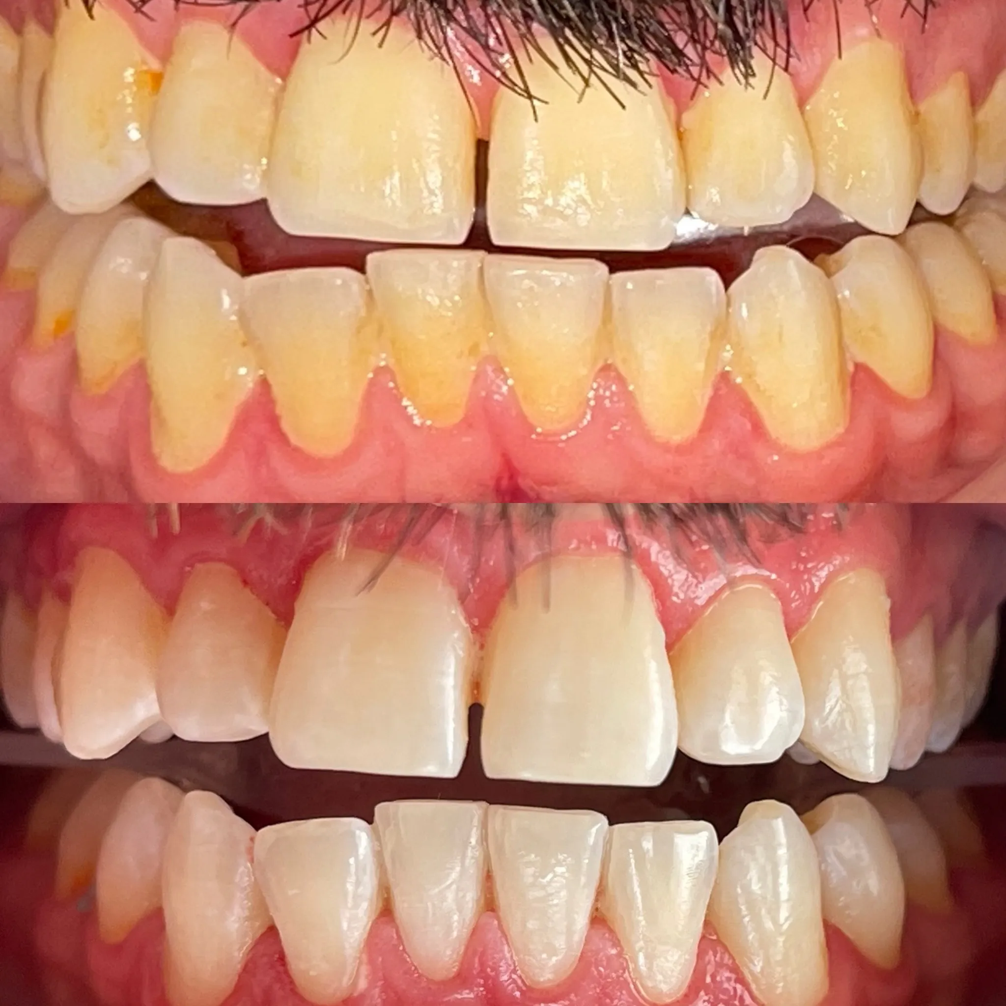 25906 teeth whitening before after full face image2