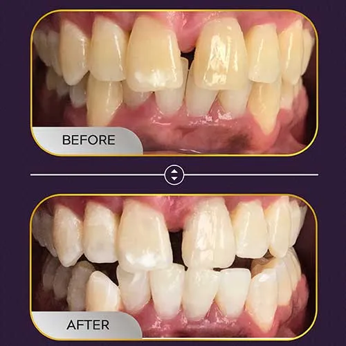 25906 teeth whitening before after full face image3
