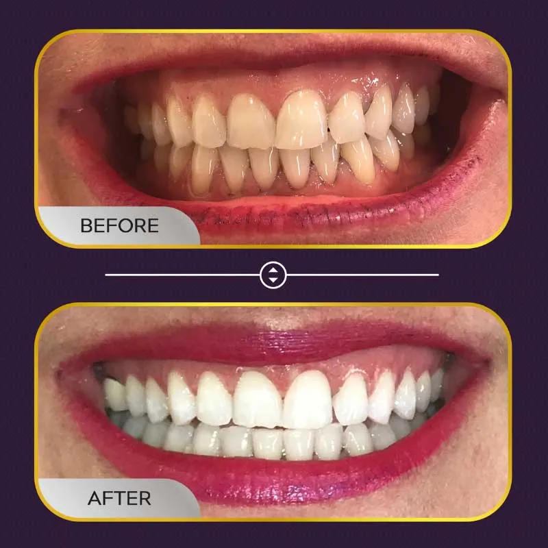 25906 teeth whitening before after full face image4