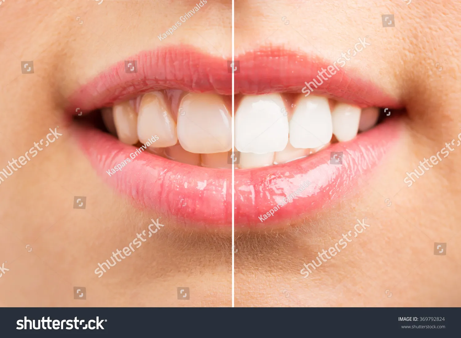 25906 teeth whitening before after full face image5