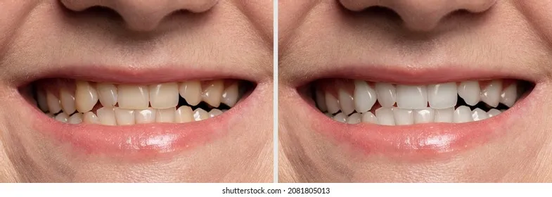 25906 teeth whitening before after full face image6