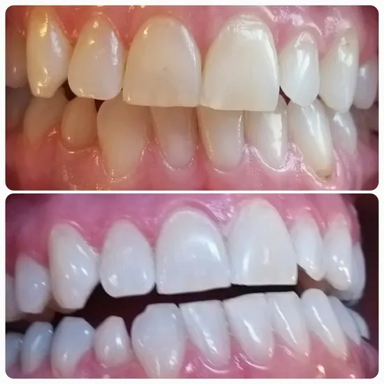 25906 teeth whitening before after full face image7