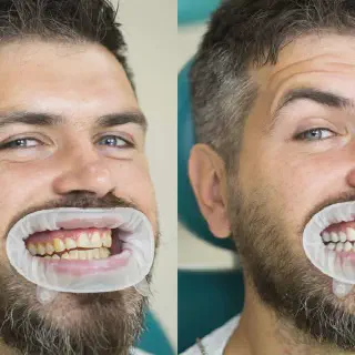 /img/25906-teeth-whitening-before-after-full-face-image8.webp