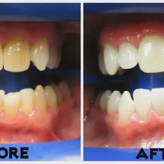 /img/25908-zoom-before-after.webp