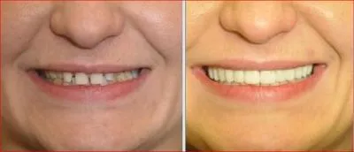 25908 zoom procedure