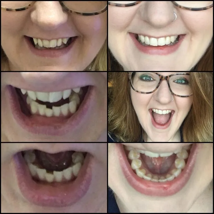 25914 smile direct club results