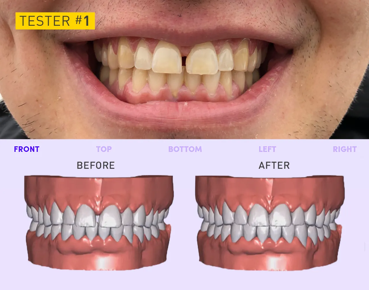 25914 smile direct club whitening gel