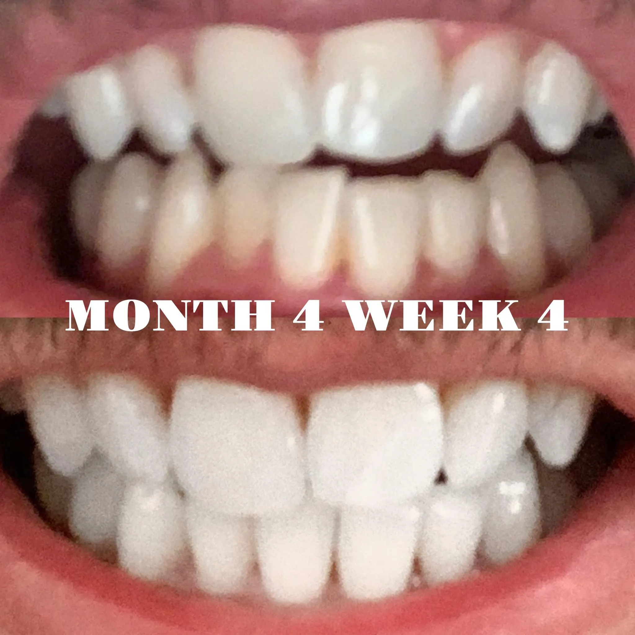 25914 whitening gel application