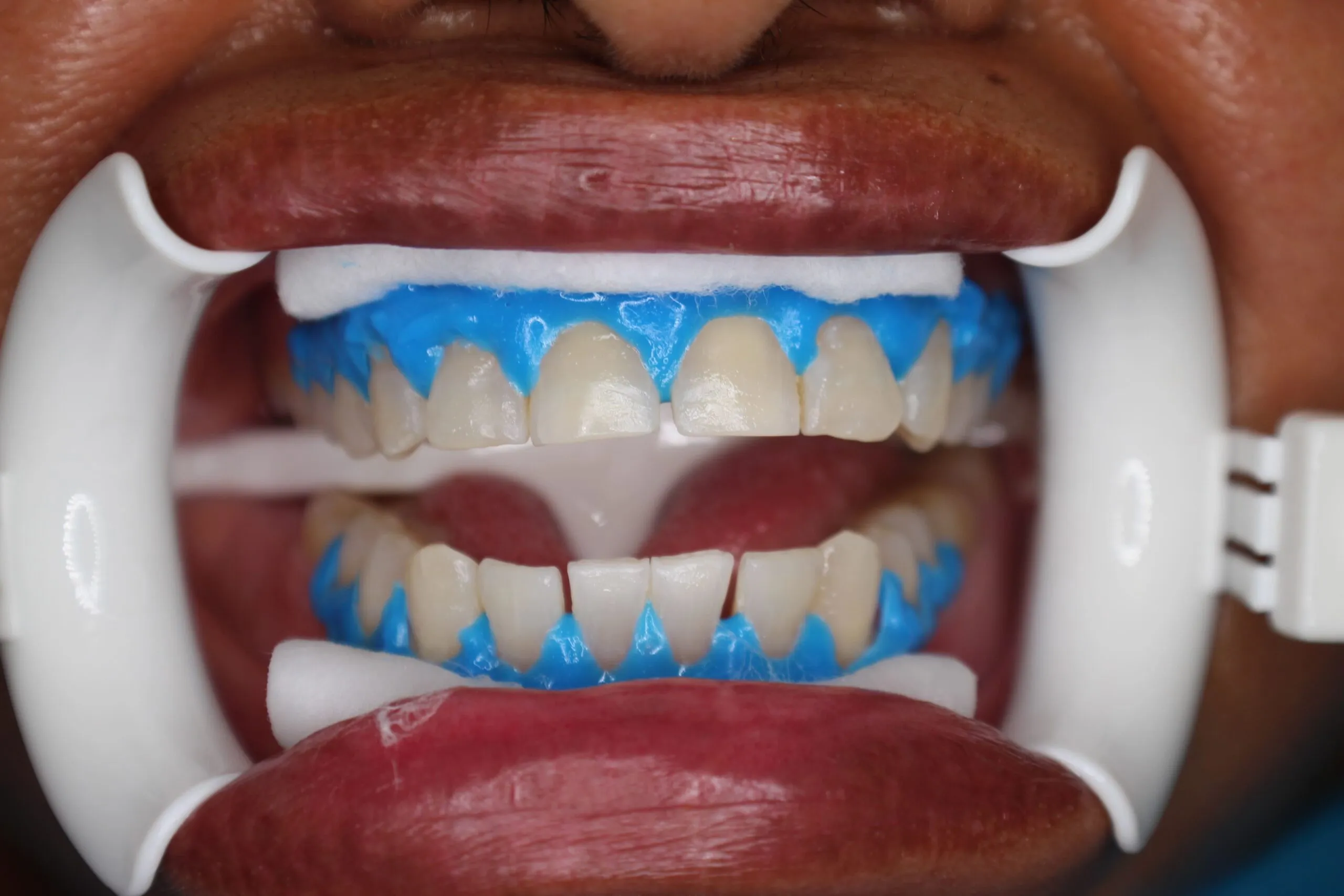 25915 teeth whitening oral health
