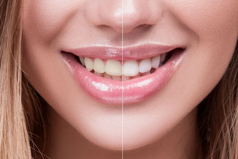 25925 at home teeth whitening kit