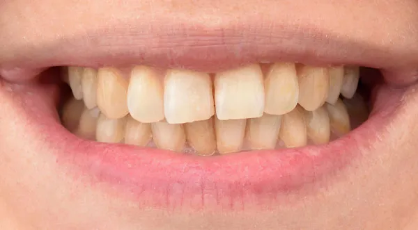 25925 teeth whitening avoid staining