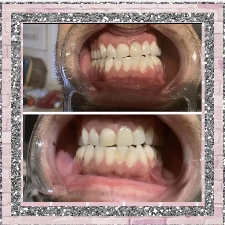 25928 professional teeth whitening