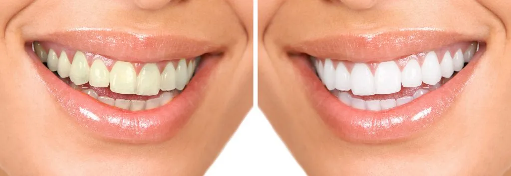 25928 teeth whitening strips