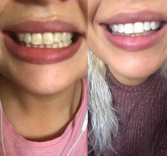 25931 preventing tooth sensitivity