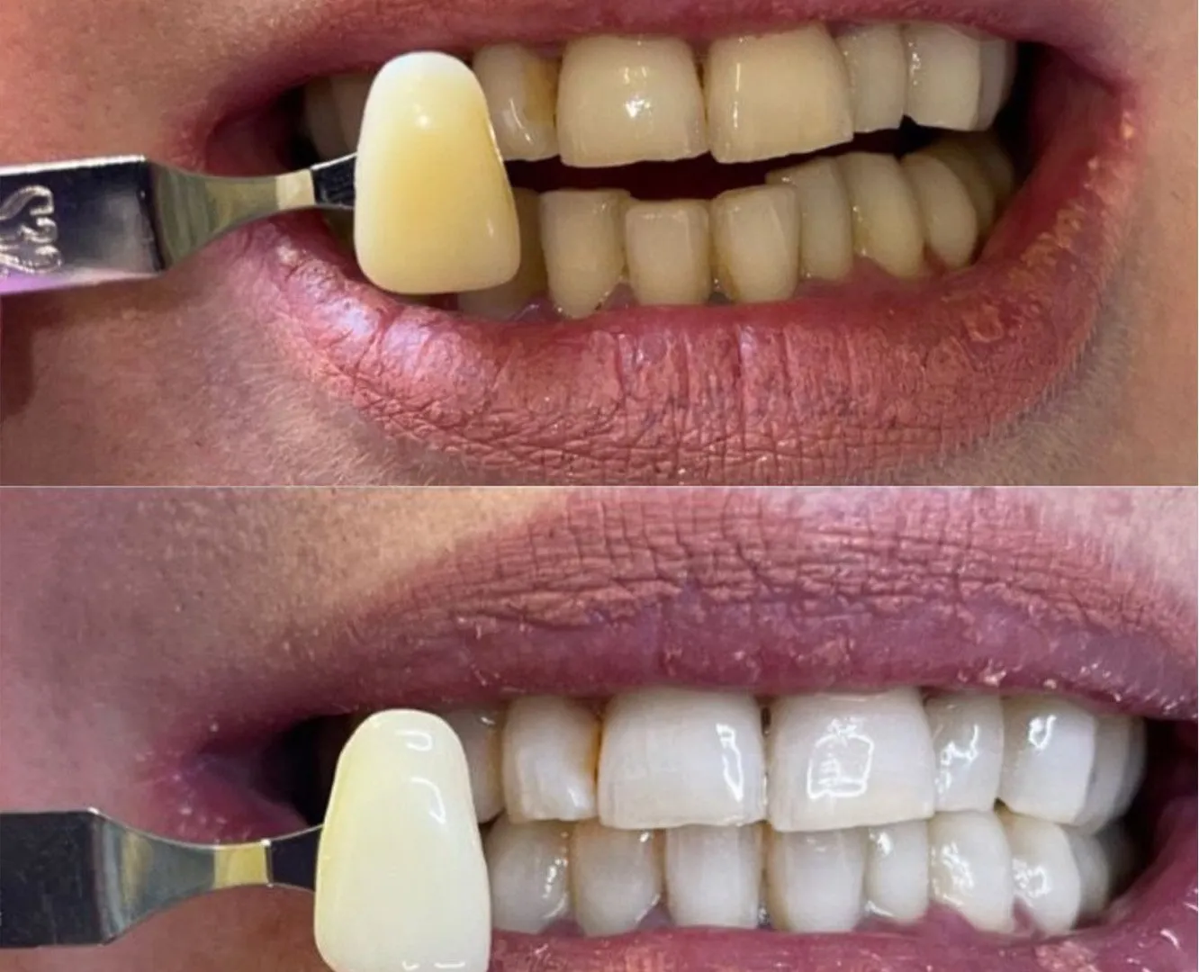 /img/25932-teeth-whitening-alternatives.webp
