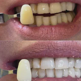 /img/25932-teeth-whitening-alternatives.webp