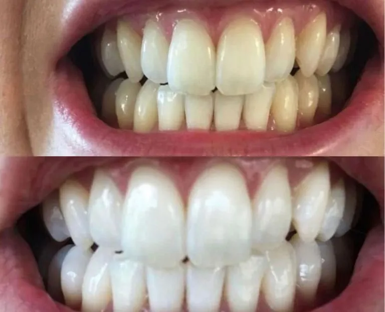 25932 teeth whitening ingredients