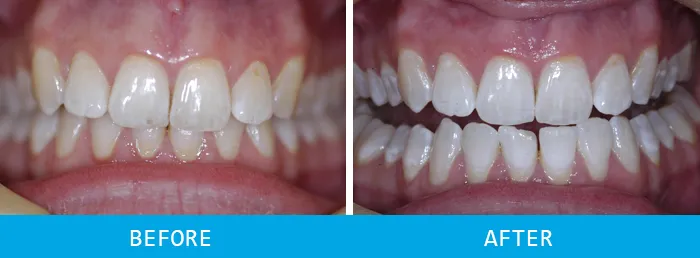 25933 bright smile tips