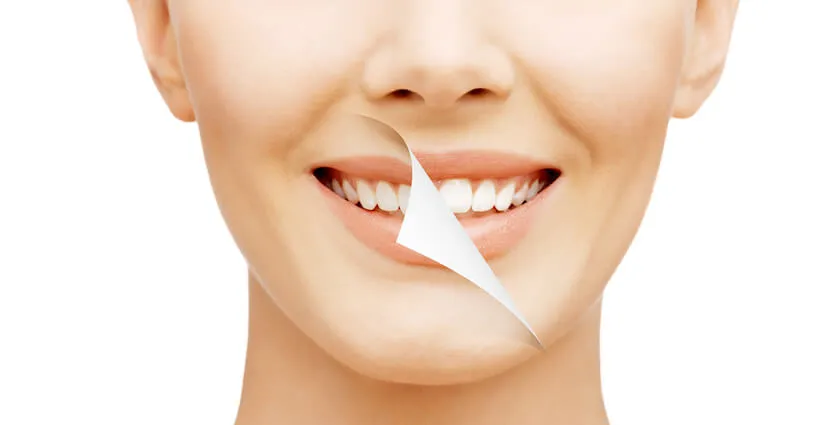 25934 teeth whitening confidence