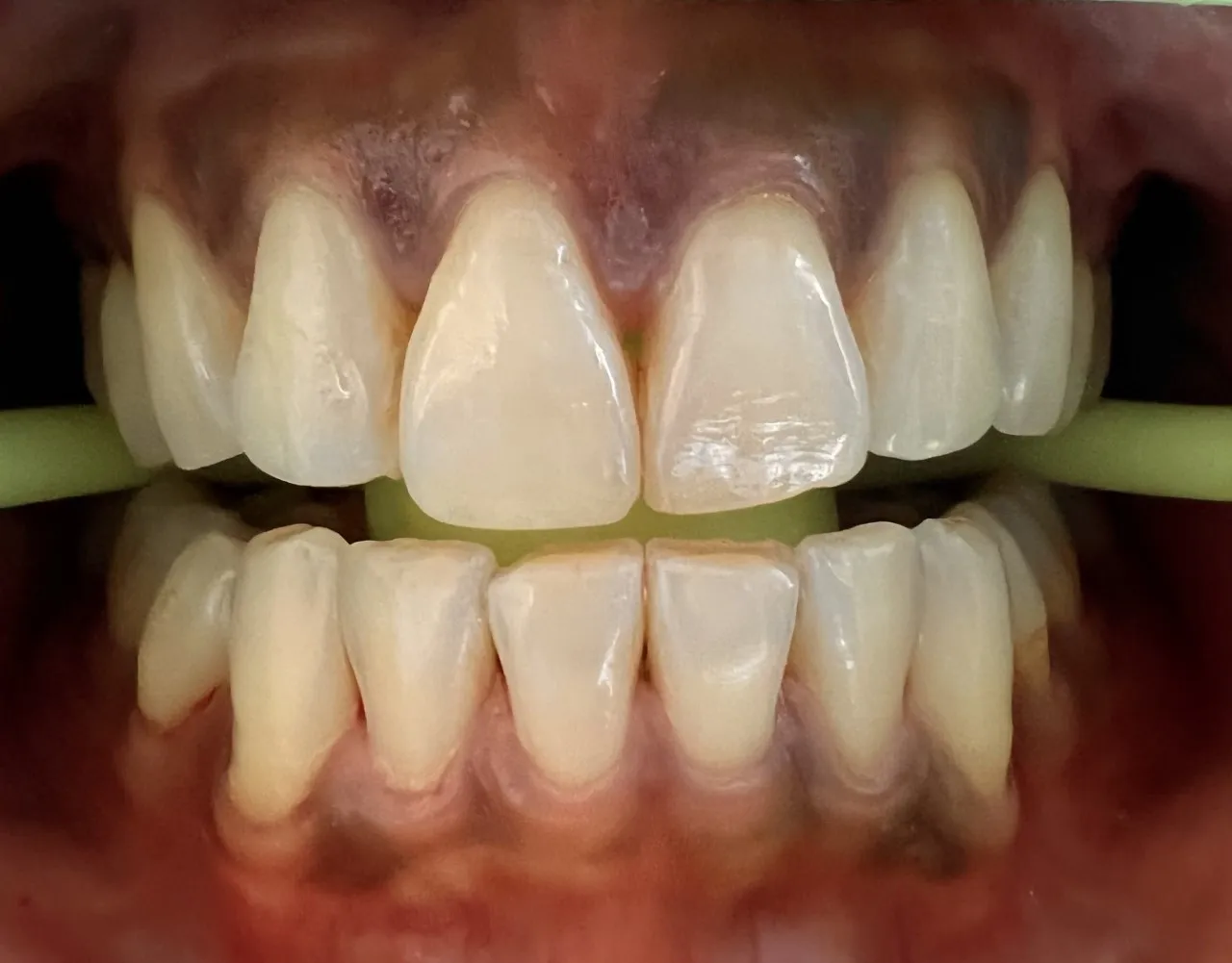 25934 teeth whitening cost