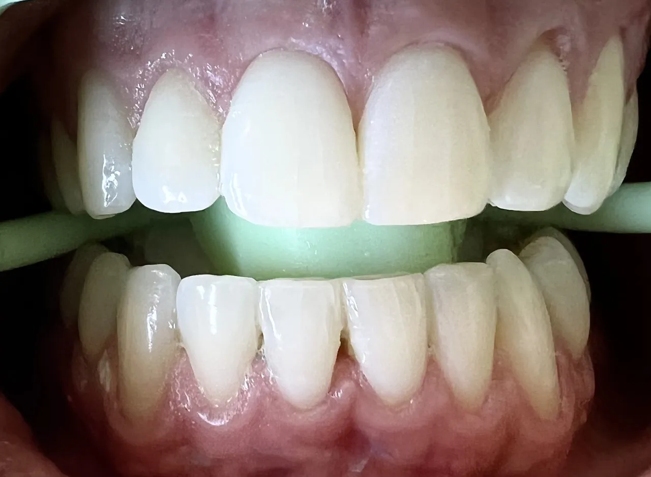 25934 teeth whitening procedure