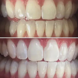 /img/25934-teeth-whitening-products.webp