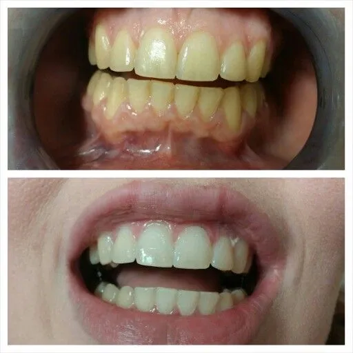 25937 buckhead teeth whitening oral hygiene