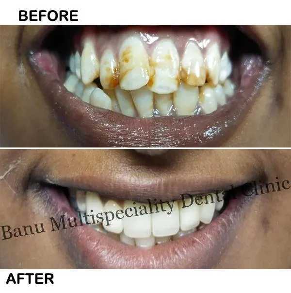 25937 teeth whitening lifestyle choices