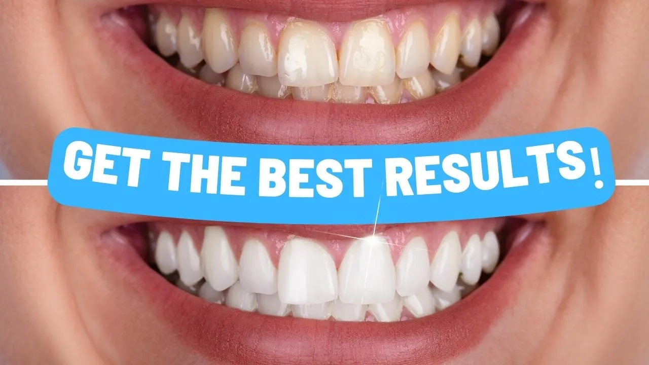 25941 laser teeth whitening