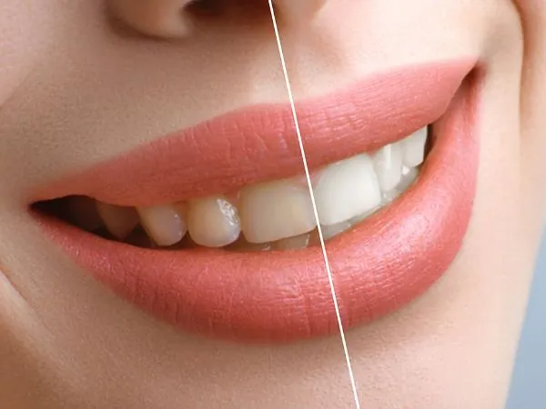 25952 sensitive teeth