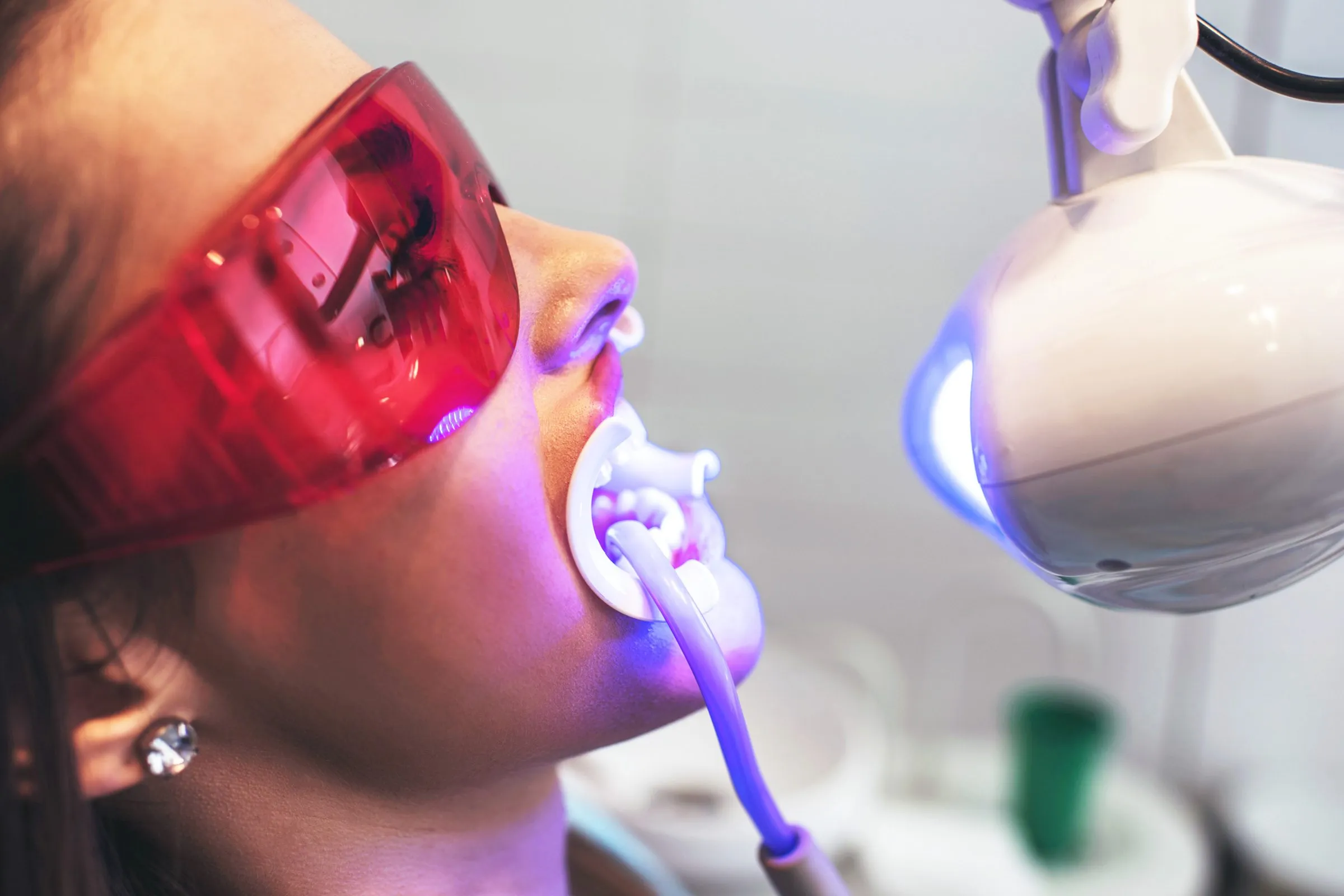 25952 teeth whitening results