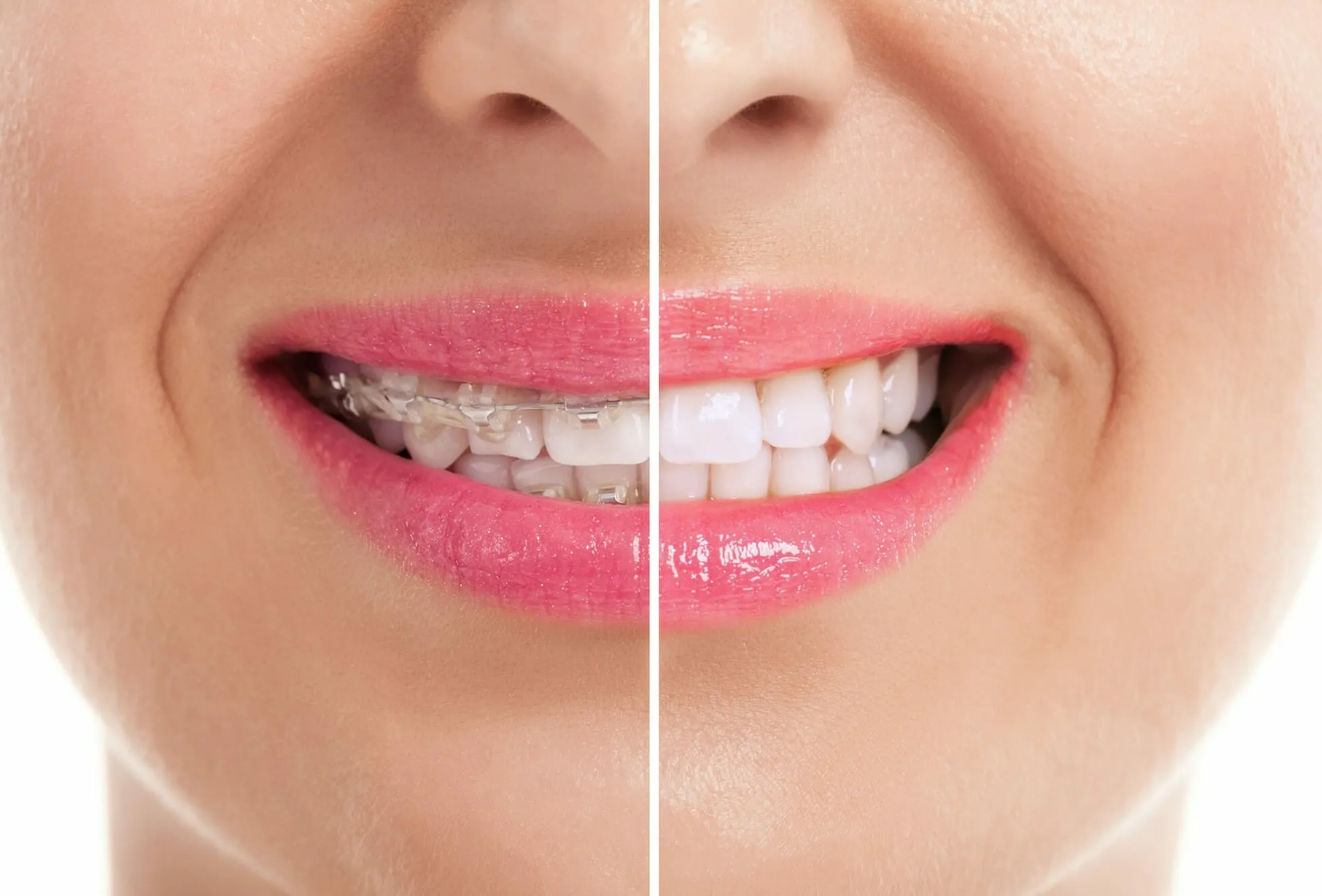 25955 take home whitening kit