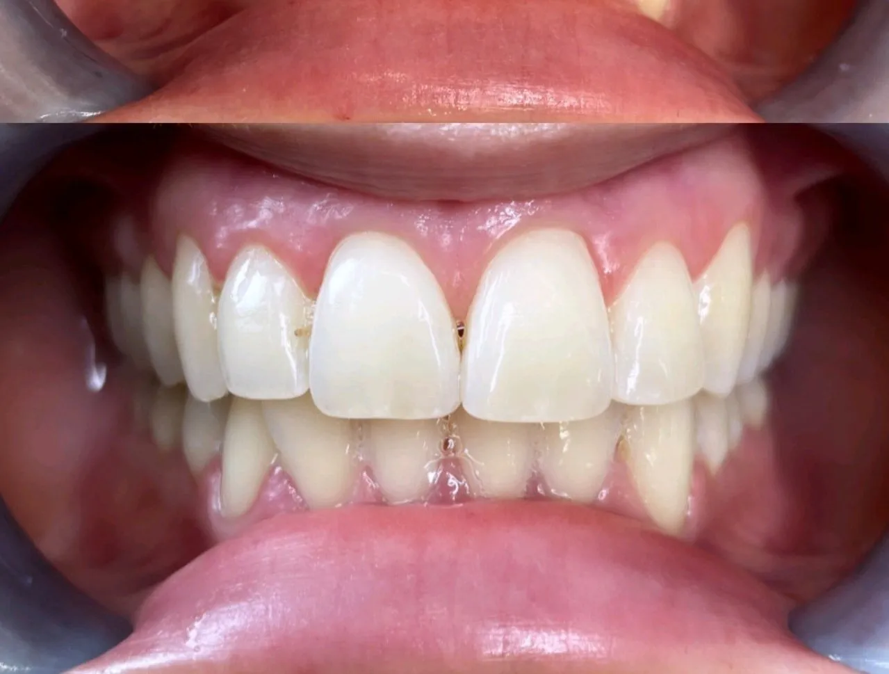 25967 teeth whitening malahide 2
