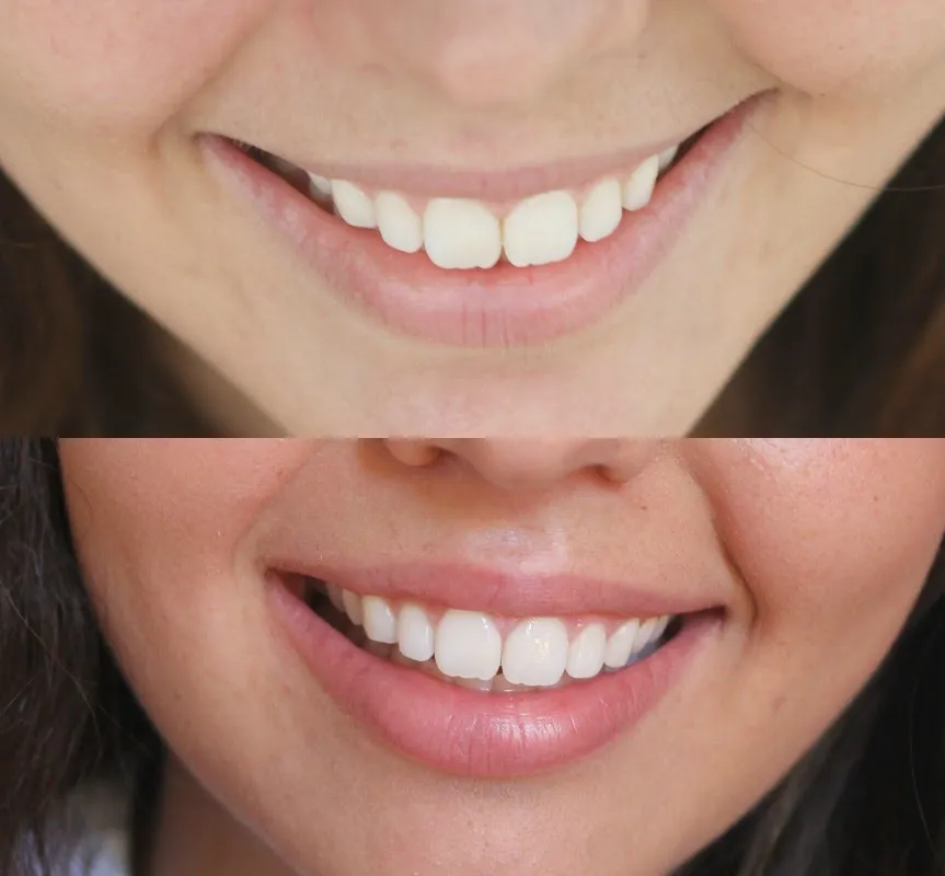 /img/25969-teeth-whitening-results.webp