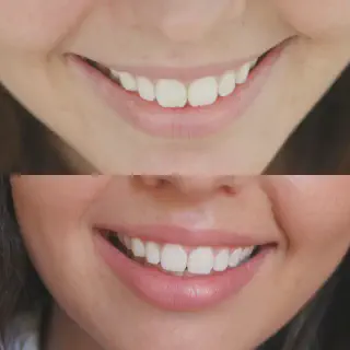 /img/25969-teeth-whitening-results.webp
