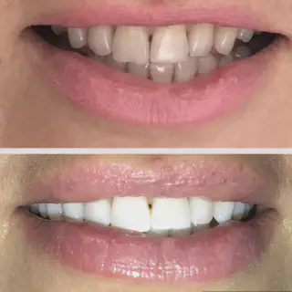 /img/25972-teeth-whitening-mount-pleasant-8.webp