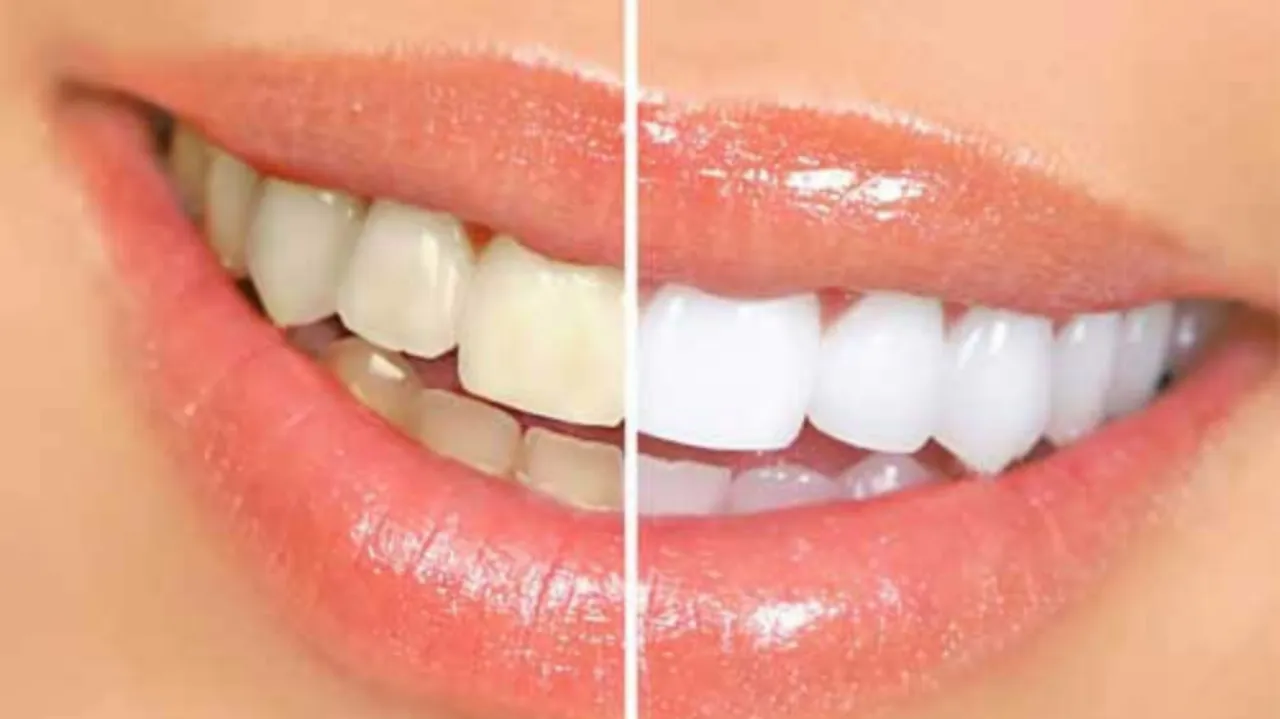 /img/25973-alternatives-to-teeth-whitening.webp