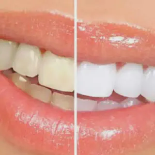 /img/25973-alternatives-to-teeth-whitening.webp